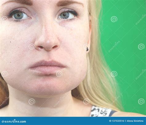 Teeth Problem Gumboil Flux And Swelling Of The Cheek Closeup Of