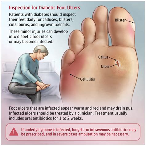 Diabetic Foot Ulcers Neurology JAMA JAMA Network Ulcers