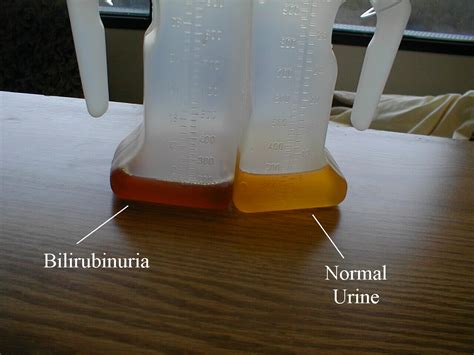 Bilirubinuria Dark Colored Urine Resulting From Abnormally Grepmed