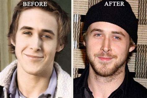 Ryan Gosling Nose Job Photo Before And After Celeb Surgerycom