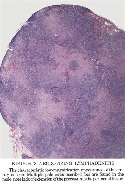 Pathology Outlines Kikuchi Disease