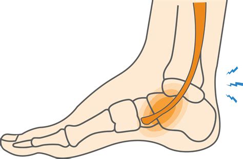 What Is Posterior Tibial Tendonitis How To Relieve Foot Pain Upswing Health