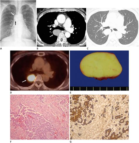 Pleural Localized Malignant Mesothelioma Mimicking A Benign Solitary