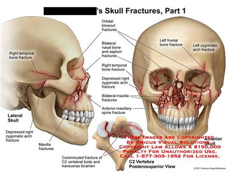 AMICUS Illustration Of Amicus Injury Skull Fractures Part 1 Temporal
