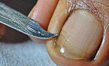 See more ideas about black toenail fungus, toenail fungus, toe nails. How to Remove Keratin or Debris under the Toenail | Nail ...
