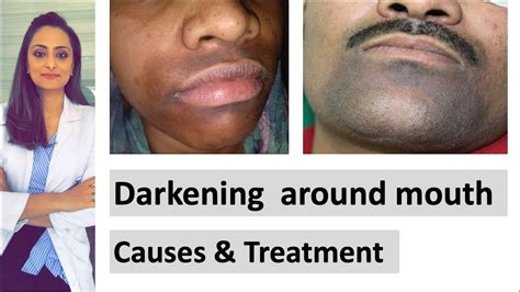 Darkening Around Mouth Causes Treatment Dermatologist Dr