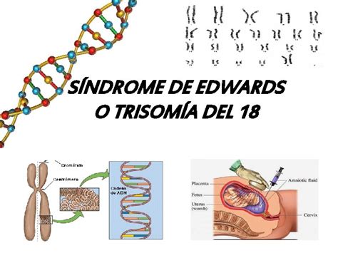 SNDROME DE EDWARDS O TRISOMA DEL 18 INDICE