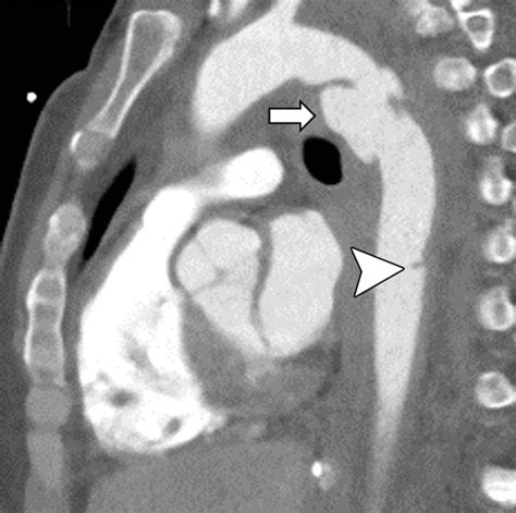 Minimal Aortic Injury Mechanisms Imaging Manifestations Natural