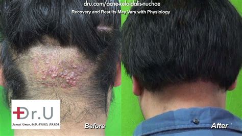 Acne Keloidalis Nuchae Patient Results Dr U Hair And Skin Clinic Fue