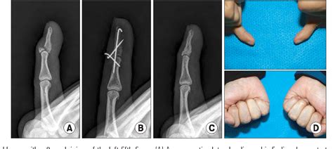 Figure 3 From Anatomic Reduction Of Mallet Fractures Using Extension