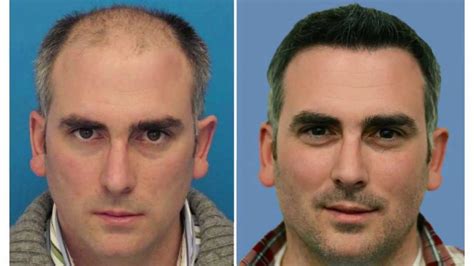 Hair Transplants In The UK What To Do Before And What To Expect After