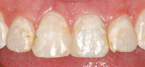 Is tooth bonding work covered by dental insurance? Dental Bonding Atlanta GA › Killian Hill Dental Care - Lilburn, GA