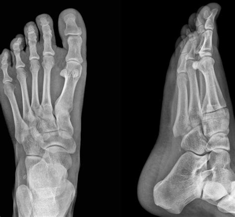 What Are The Symptoms Of A Toe Stress Fracture With Pictures