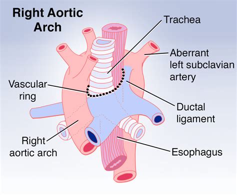 Aortic Arch Developmental Defects