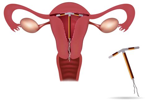 My wife and i are having a baby and do not have insurance, i just tell you what we have learned. IUD Insertion Santa Monica | IUD Insertion Los Angeles