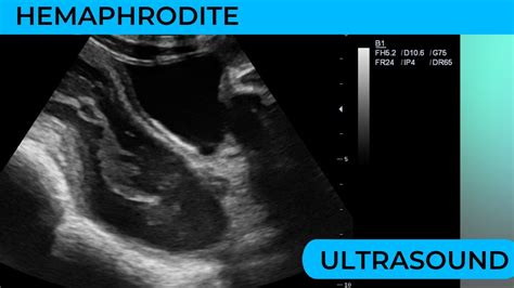 Hermaphrodite Both Male And Female Genitalia On Ultrasound Scan