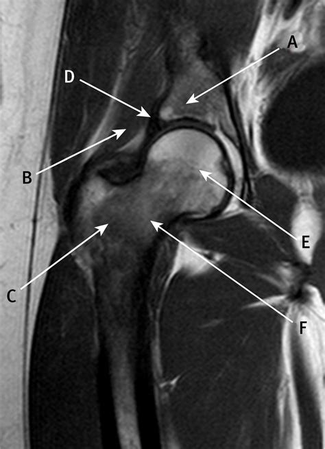 Coronal T Weighted Magnetic Resonance Imaging Of The Hip The Bmj