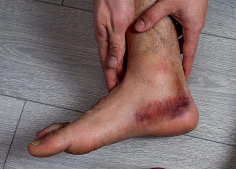 Medial Deltoid Ligament Hot Sex Picture