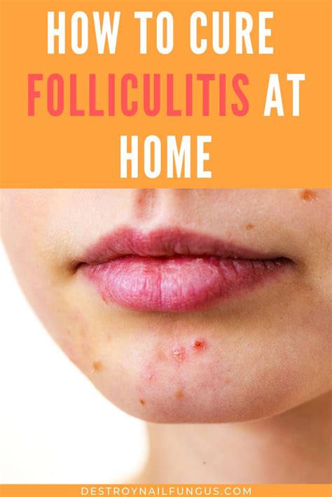 Are You Suffering From Folliculitis If So You May Have Red Bumps From