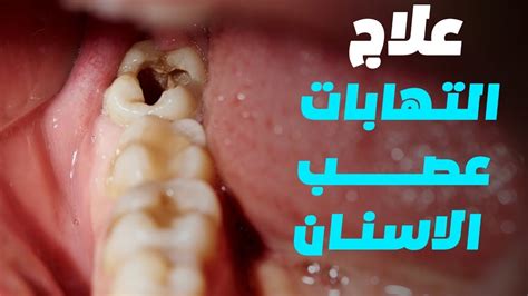 هل علاج الاسنان يفطر في رمضان