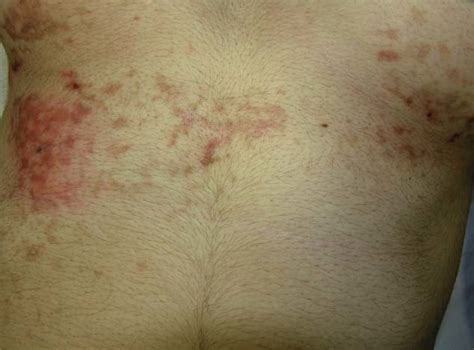 Erythematous Reticulated Macules And Crusted Papules Over The Chest