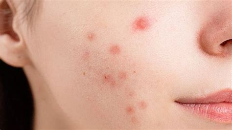 Best 10 Home Remedies For Skin Rashes