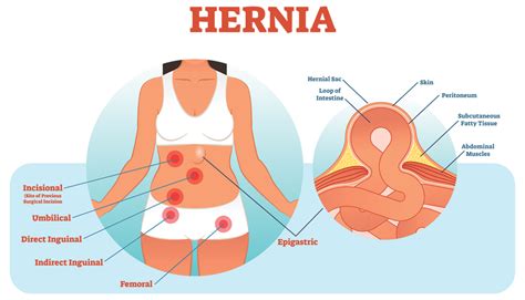 Right Sided Inguinal Hernia Icd 10 Broken Curve
