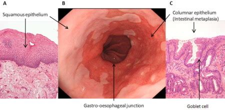 Barrett Esophagus Stepwards