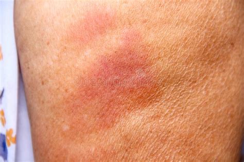 Red Rash Allergy Inflammation On Little Finger Stock Image Image Of