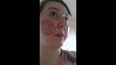 Day 2 Of Co2 Laser Treatment For Pitted Acne Scars Youtube