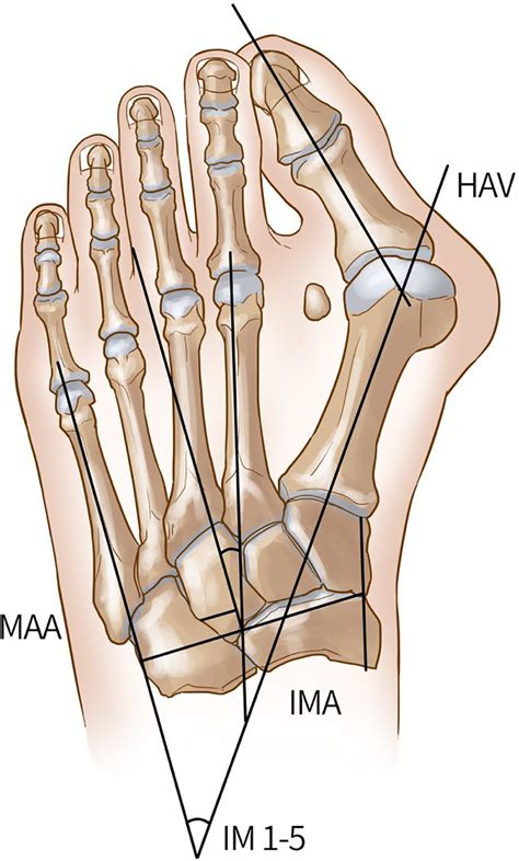 Effects Of Singlefoot Centered And Doublefoot Centered Xray Projection On Hallux Valgus