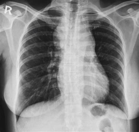 Mediastinal Hodgkins Lymphoma Radiology Case