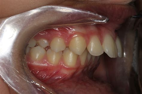 Protruding Front Teeth Contour Orthodontists