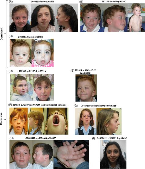 Clinical Images Showing Noonan Like Features In Patients Where Consent