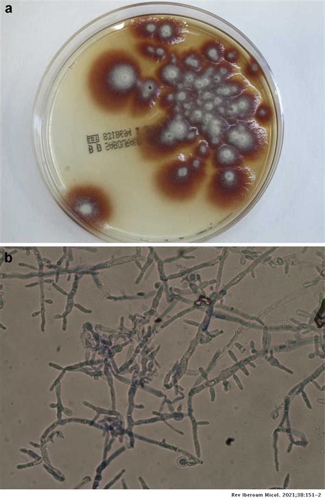 Kerion Celsi Caused By Trichophyton Tonsurans With Dermatophytid