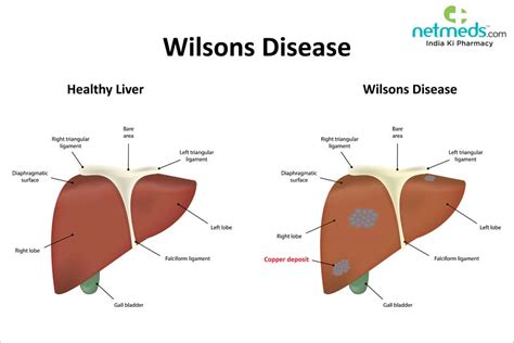 Wilsons Disease Causes Symptoms And Treatment Netmeds