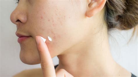 What Are The Different Types Of Acne And How Do I Treat Them