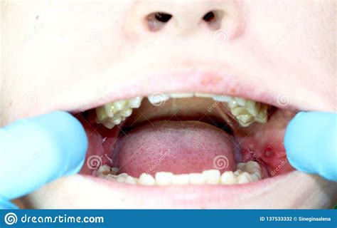 Operation Removal Of Wisdom Teeth Eights Stitching Postoperative