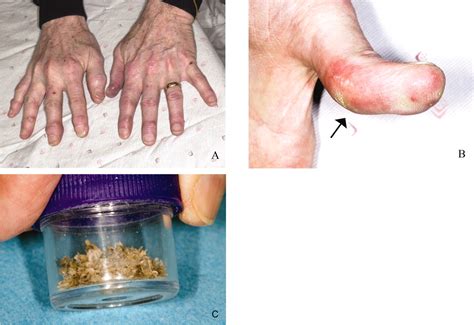 Many other diseases such as gout , fibromyalgia , and lupus may resemble rheumatoid arthritis, so the doctor will rule out these conditions before making a diagnosis of ra. Unusual Draining Nodules in a Patient with Rheumatoid ...