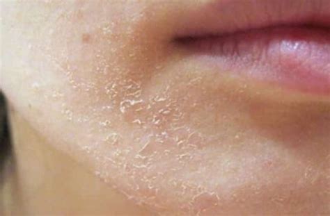 6 Causes Of Dry Skin On Chin And Treatment Remedies Skincarederm