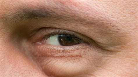 What Are The Possible Causes Of Swelling Under The Eyes