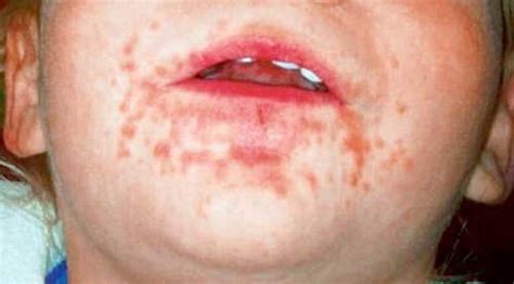 Healthoolhand Foot And Mouth Disease Rash Pictures Atlas Of Rashes