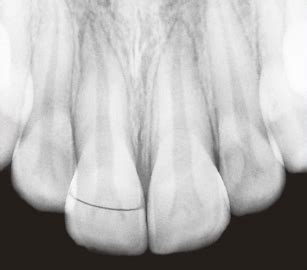 Crown-Root Fracture | Pocket Dentistry
