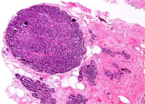 Atypical Lobular Hyperplasia And Lobular Carcinoma In Situ At Core Needle Biopsy Of The Breast