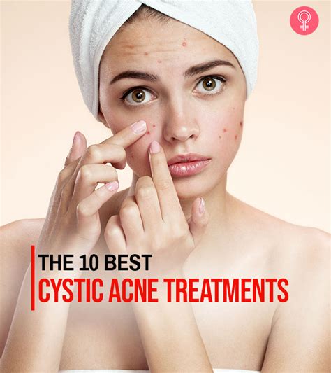 12 Best Cystic Acne Treatments That Work Like A Charm 2023 Ladie Life