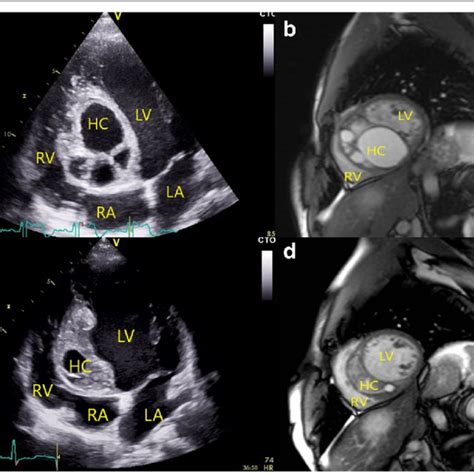Intraoperative View Of The Hydatid Cyst Through The Tricuspid Valve