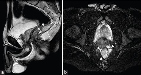 Magnetic Resonance Imaging Of The Anal Region Clinical Applications