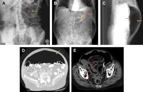 Imaging Of Gastrointestinal Tract Perforation Radiology Key