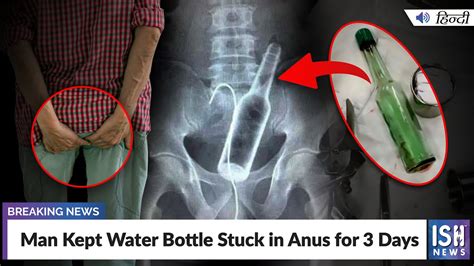 Man Kept Water Bottle Stuck In Anus For 3 Days Ish News Youtube