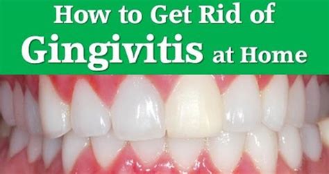 How To Get Rid Of Gingivitis Fast At Home
